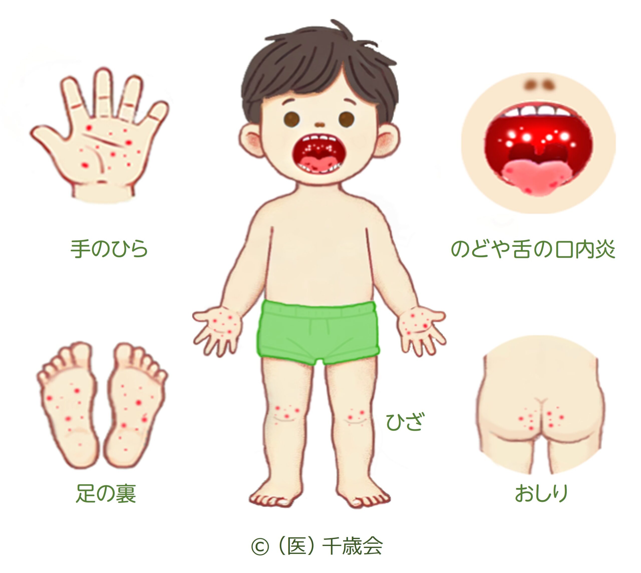 手足口病挿絵