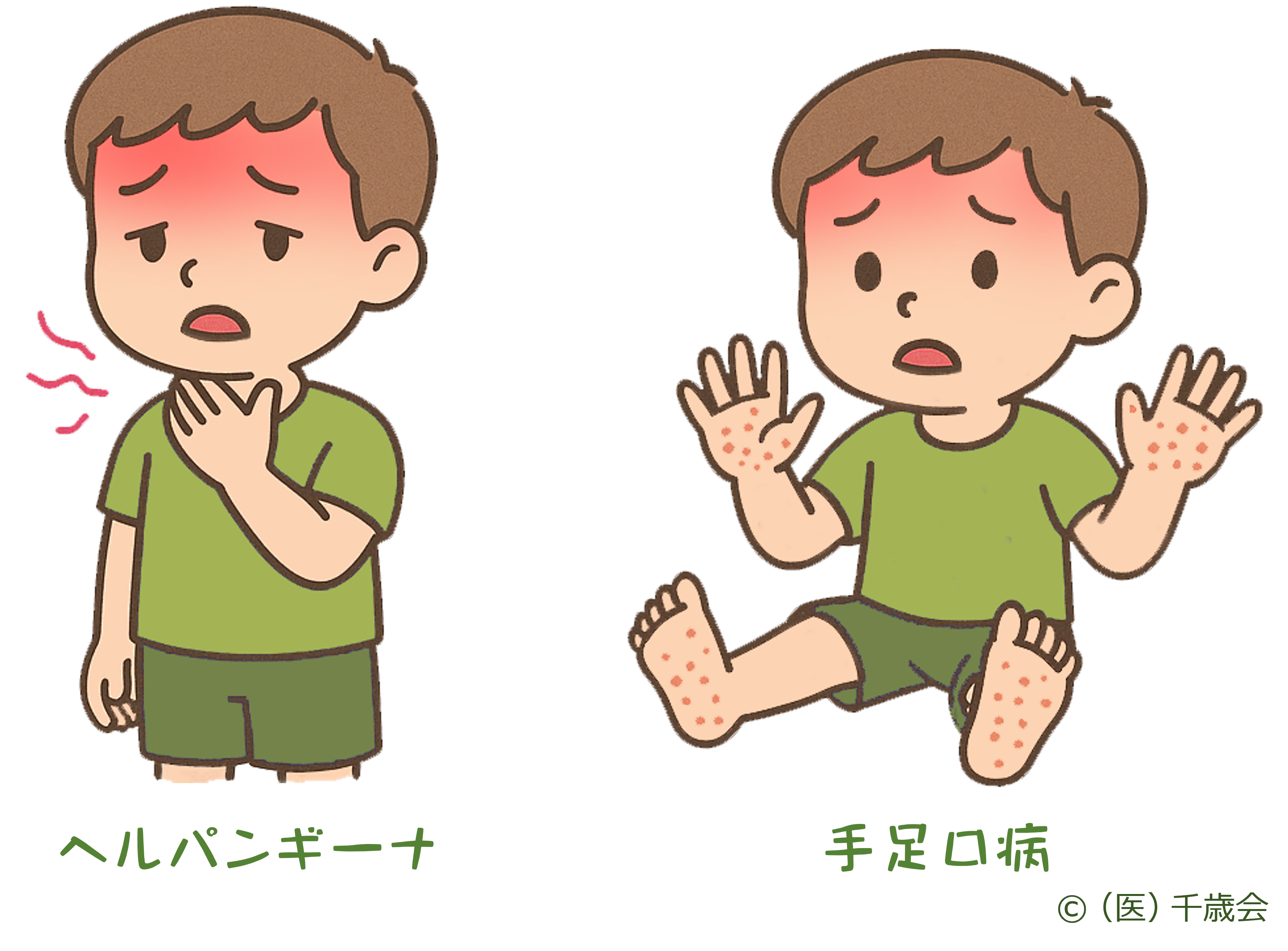 ヘルパンギーナと手足口病の挿絵