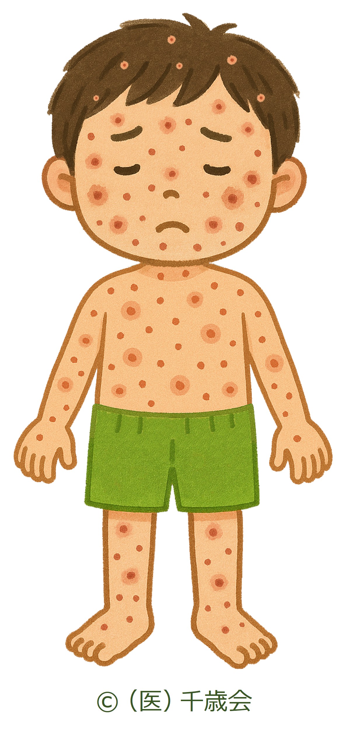 水ぼうそうの幼児